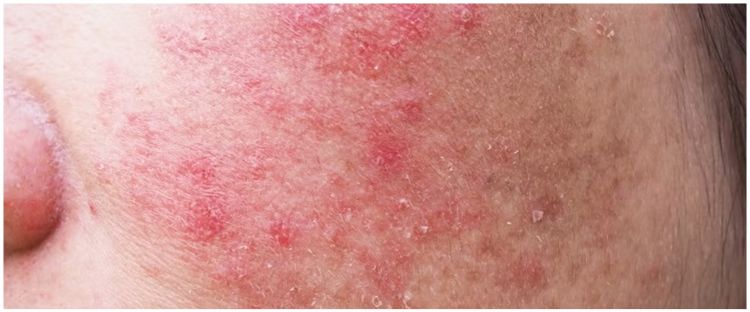 Cara menggunakan lidah buaya untuk mengatasi iritasi kulit